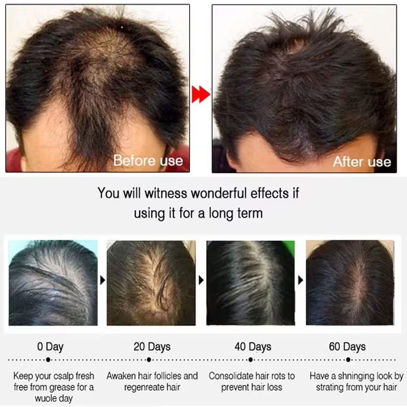 빠른 생강 모발 성장 스프레이, 모발 뿌리 강화, 탈모 - Hair Care Natural 리뷰 및 가격